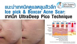 แนะนำเทคนิคดูแลหลุมสิวลึก Ice pick & Boxcar Acne Scar: เทคนิค UltraDeep Pico Technique